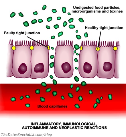 leaky gut, detox