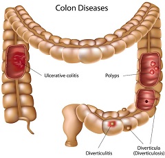 Colon Cleanse