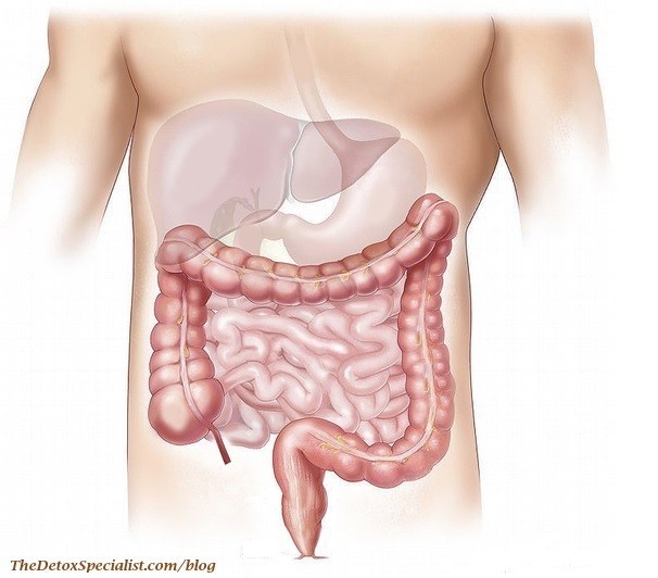 colon cancer